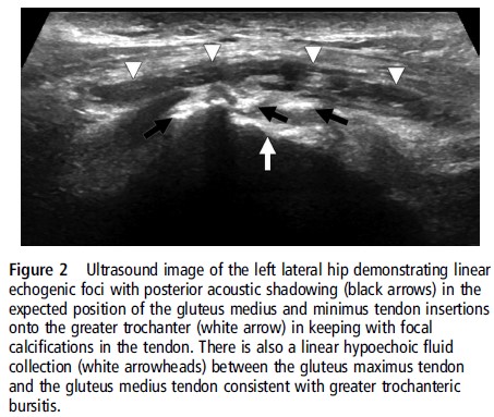 Tendinitis glúteo medio foro